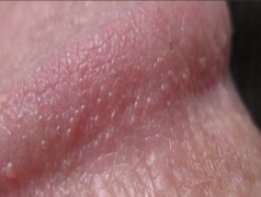 男性尖锐湿疣的早期症状图片?”
